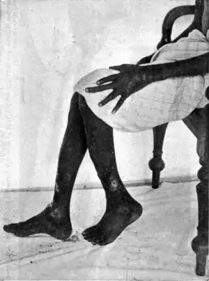 Tropical Diseases - Fig 92.png